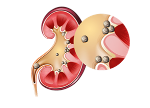 Cálculos Urinários