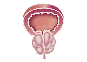 Aumento da Próstata