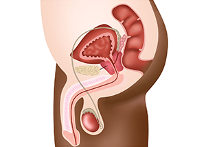 Câncer de Próstata